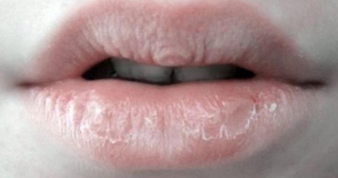 Bibir Kering dan Mengelupas Saat Demam? Ini 4 Alasan Medis di Baliknya