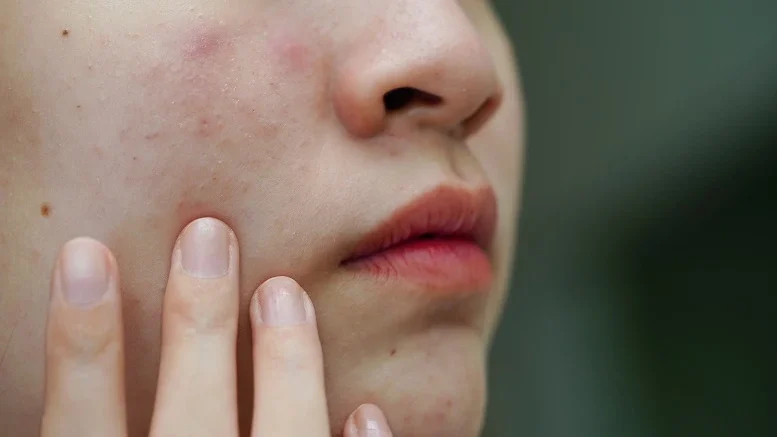 Wajah Gampang Kemerahan dan Perih? Simak 4 Cara Ampuh Merawat Skin Barrier Ini
