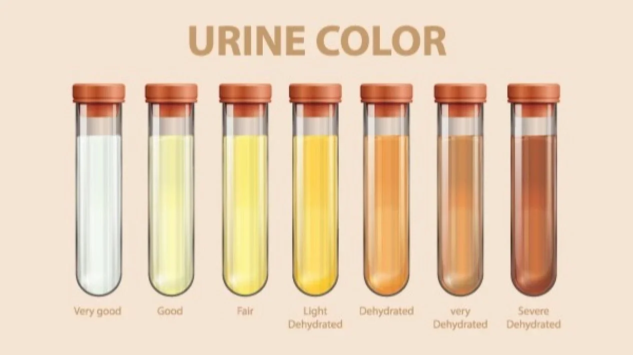 Cara Mengetahui Tubuh Kekurangan Cairan dari Warna Urine