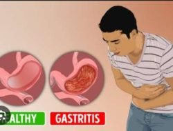 Ini Informasi Penting Aturan Minum Obat Maag