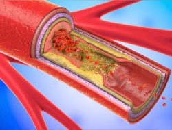 Diantaranya Olahraga Rutin, Ini Lima Tips Cara Cegah Penyempitan Pembuluh Darah
