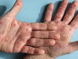 Warga Sintang Diduga Cacar Monyet, Sampel Medis Dikirim ke Jakarta