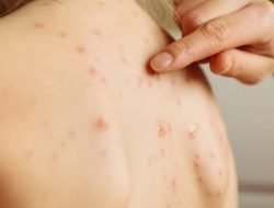 RSUD Sekadau Imbau Warga Tetap Tenang dan Waspada Terkait Berita Cacar Monyet