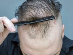 Cegah Kebotakan Dini! Cara Efektif Mengatasi Rambut Rontok Tak Wajar