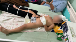 Kondisi Qanisha Riskya Almahyra (2) saat dirawat intensif di RS Medika Djaya Parit H. Husin 1 Pontianak setelah mengalami kecelakaan di Ketapang. (Dok. Ist)