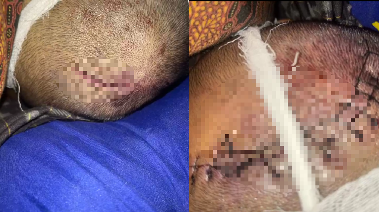 Kondisi bagian kepala jenazah Rio Fanderi sebelum di makamkan, rio merupakan mahasiswa IAIN Pontianak yang meninggal dunia setelah mengalami cedera kepala parah. (Dok. Ist)