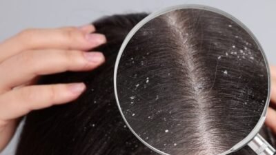 "Ketombe bikin tidak percaya diri? Atasi dengan 4 cara efektif ini, mulai dari memilih sampo antijamur yang tepat hingga eksfoliasi kulit kepala."