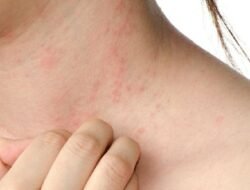 Waspada! Ini Ciri-Ciri DBD yang Seringkali Muncul Tanpa Disadari