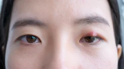 "Mata bintitan (hordeolum) bisa sangat mengganggu. Cari tahu 4 alasan umum kenapa mata bisa bintitan, mulai dari tangan kotor hingga kosmetik."