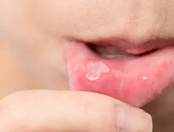 Bukan Cuma Panas Dalam, Ini 5 Penyebab Sariawan yang Sering Tidak Disadari