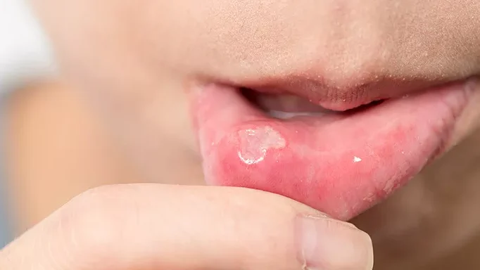 "Sering sariawan padahal rajin minum air? Ternyata bukan cuma panas dalam. Simak 5 penyebab sariawan yang jarang disadari, mulai dari stres hingga pasta gigi. "