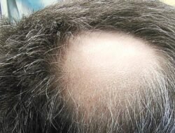 Awas! Stres Berpikir Ternyata Bisa Bikin Rambut Rontok Massal. Ini 4 Alasan Ilmiahnya