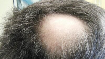 Awas! Stres Berpikir Ternyata Bisa Bikin Rambut Rontok Massal. Ini 4 Alasan Ilmiahnya