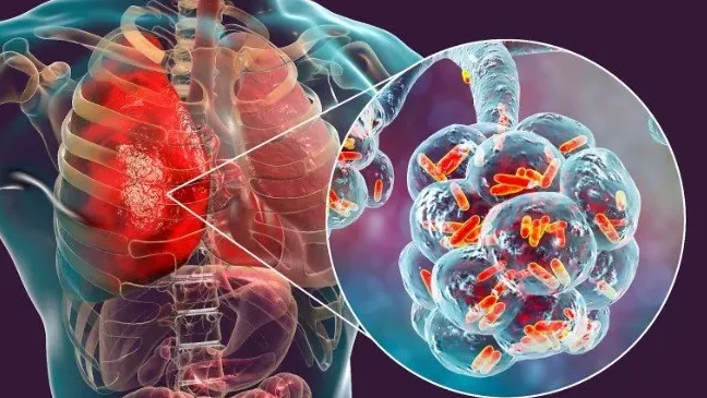 "Pneumonia bisa berakibat fatal namun sangat bisa dicegah. Simak 6 langkah efektif cara mencegah pneumonia, mulai dari nutrisi, vaksinasi, hingga pola hidup sehat."