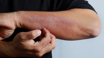 Bukan Cuma Dingin! Ini 8 Penyebab Kulit Kering Disertai Gatal