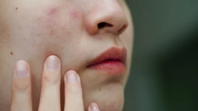 "Wajah terasa perih dan gampang jerawatan? Itu tanda pertahanan kulit sedang lemah. Ikuti 4 tips merawat skin barrier ini agar kulit kembali sehat dan kuat."