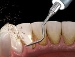 Daftar Perawatan Gigi Gratis yang Ditanggung BPJS