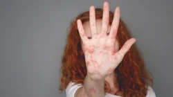 "Kemenkes melaporkan lonjakan suspek campak di Indonesia hingga tiga kali lipat pada Januari 2026. Kenali gejala dan langkah pencegahannya di sini."