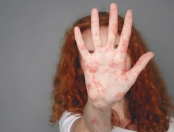 Waspada! Kasus Suspek Campak di Indonesia Melonjak Tiga Kali Lipat pada Awal 2026