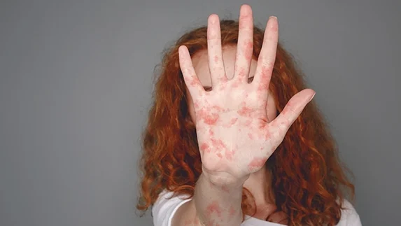 "Kemenkes melaporkan lonjakan suspek campak di Indonesia hingga tiga kali lipat pada Januari 2026. Kenali gejala dan langkah pencegahannya di sini."