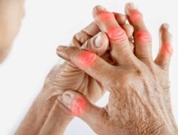 Nyeri Sendi Mendadak? 5 Ini Langkah Darurat yang Wajib Dilakukan Saat Asam Urat Kambuh