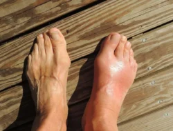 Sering Dikira Sama, Ini Perbedaan Vital Asam Urat dan Rematik yang Wajib Tahu