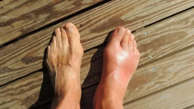 "Banyak yang salah kaprah menyamakan asam urat dan rematik. Kenali beda gejala, penyebab, dan lokasi nyerinya di sini agar tidak salah obat."