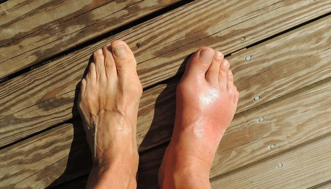 "Banyak yang salah kaprah menyamakan asam urat dan rematik. Kenali beda gejala, penyebab, dan lokasi nyerinya di sini agar tidak salah obat."