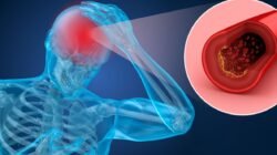 "Seorang perempuan di Jawa Tengah mendadak bicara dengan logat Madura setelah terserang stroke. Simak penjelasan medis Foreign Accent Syndrome (FAS) dan area otak yang memicunya."