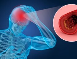 Perempuan di Jawa Mendadak Logat Madura Usai Stroke, Ternyata Ini Penyebab Medisnya