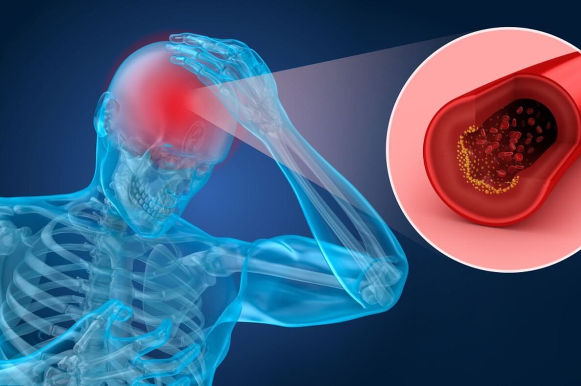 "Seorang perempuan di Jawa Tengah mendadak bicara dengan logat Madura setelah terserang stroke. Simak penjelasan medis Foreign Accent Syndrome (FAS) dan area otak yang memicunya."