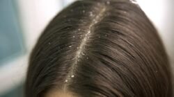 "Sering garuk kepala karena gatal? Kenali 5 sumber ketombe yang sebenarnya, mulai dari jamur Malassezia hingga pengaruh produk perawatan rambut yang tidak cocok."