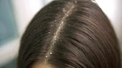 "Sering garuk kepala karena gatal? Kenali 5 sumber ketombe yang sebenarnya, mulai dari jamur Malassezia hingga pengaruh produk perawatan rambut yang tidak cocok."