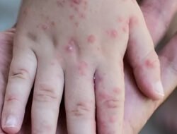 Kasus Campak Melonjak Pasien Wajib Lakukan Isolasi Mandiri