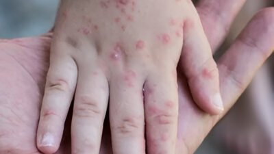 Ilustrasi - Pasien campak wajib melakukan isolasi mandiri di rumah untuk mencegah penularan. Masyarakat harus menghindari kerumunan saat mengalami gejala campak. (Dok. Ist)