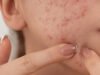 Sering Ganti Skincare Bikin Wajah Tumbuh Banyak Jerawat
