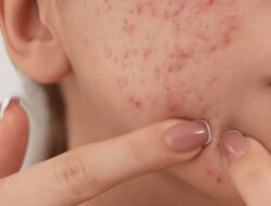 Sering Ganti Skincare Bikin Wajah Tumbuh Banyak Jerawat