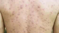 "Kemenkes melaporkan tren kasus campak di Indonesia mulai turun di minggu ke-9 tahun 2026. Simak penyebab penurunan dan pentingnya imunisasi lengkap bagi anak. "