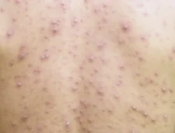 Tren Kasus Campak di Indonesia Mulai Turun, Kemenkes Beberkan Faktor Pemicunya