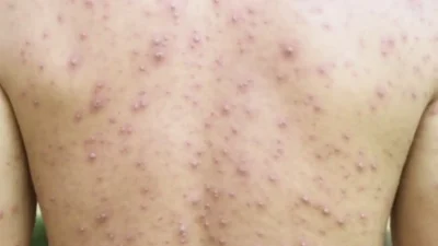 "Kemenkes melaporkan tren kasus campak di Indonesia mulai turun di minggu ke-9 tahun 2026. Simak penyebab penurunan dan pentingnya imunisasi lengkap bagi anak. "