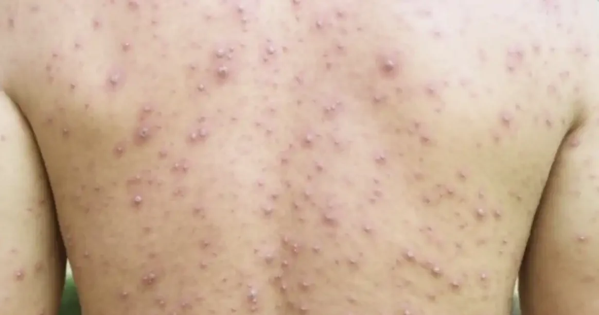 "Kemenkes melaporkan tren kasus campak di Indonesia mulai turun di minggu ke-9 tahun 2026. Simak penyebab penurunan dan pentingnya imunisasi lengkap bagi anak. "