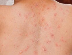 Kasus Campak Tinggi di RI, Seberapa Mudah Virus Ini Menular?