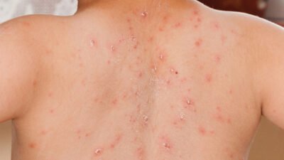 "Kasus campak di Indonesia saat ini tergolong tinggi di dunia. Ketahui seberapa mudah virus ini menular, gejala awal, hingga risiko komplikasi yang ditimbulkan. "