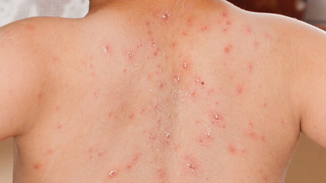 "Kasus campak di Indonesia saat ini tergolong tinggi di dunia. Ketahui seberapa mudah virus ini menular, gejala awal, hingga risiko komplikasi yang ditimbulkan. "