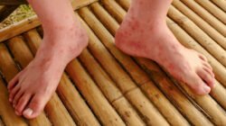 "Kemenkes ungkap 8% kasus campak di RI serang orang dewasa. Pahami penyebab tetap bisa tertular meski sudah vaksin dan risiko komplikasi yang mengintai."