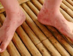 Waspada, 8 Persen Kasus Campak di Indonesia Kini Serang Kelompok Dewasa