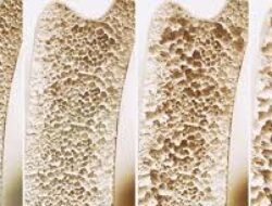 Perosi Catat 41,7 Persen Warga Kena Osteopenia, Ini Kunci Mencegah Osteoporosis Sejak Dini