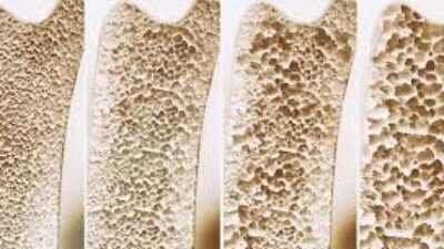 Kepadatan massa tulang perlu dijaga sejak usia produktif melalui aktivitas fisik harian dan asupan nutrisi yang tepat guna menghindari risiko pengeroposan di masa tua.