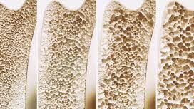 Kepadatan massa tulang perlu dijaga sejak usia produktif melalui aktivitas fisik harian dan asupan nutrisi yang tepat guna menghindari risiko pengeroposan di masa tua.