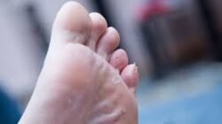 Gesekan kulit akibat sepatu sempit memicu penebalan kulit. Ketahui penyebab serta cara mencegah kapalan di kaki agar terhindar dari nyeri dan infeksi.